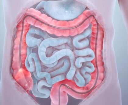 Are Colorectal Cancer Specialists Right for You?
